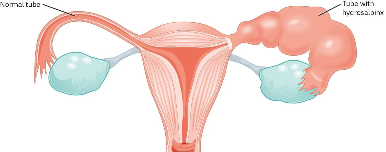 Image of uterus with normal tube on one side and Tube with hydrosalpinx.