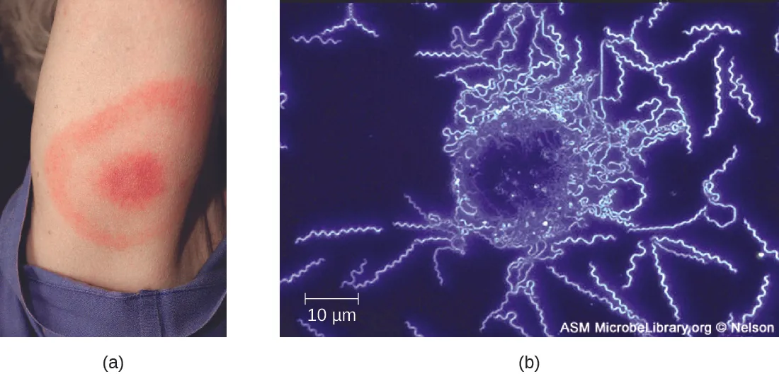 a) a rash with a red ring that contains a red spot in the center. B) A micrograph of spiral shaped cells.