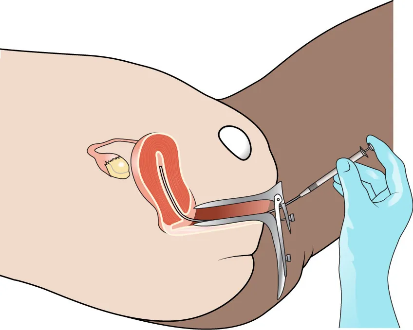 An image of washed sperm being inserted into the uterus with a thin catheter.