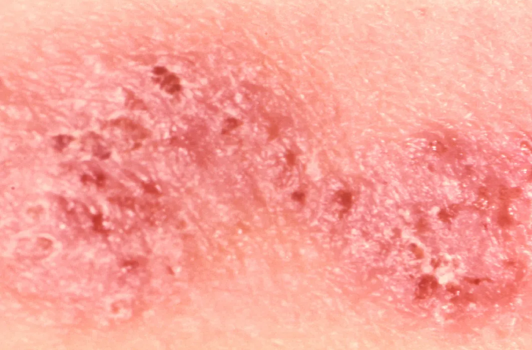 A closeup photo of skin with eczema shows small, scaly, enflamed patches on the skin.
