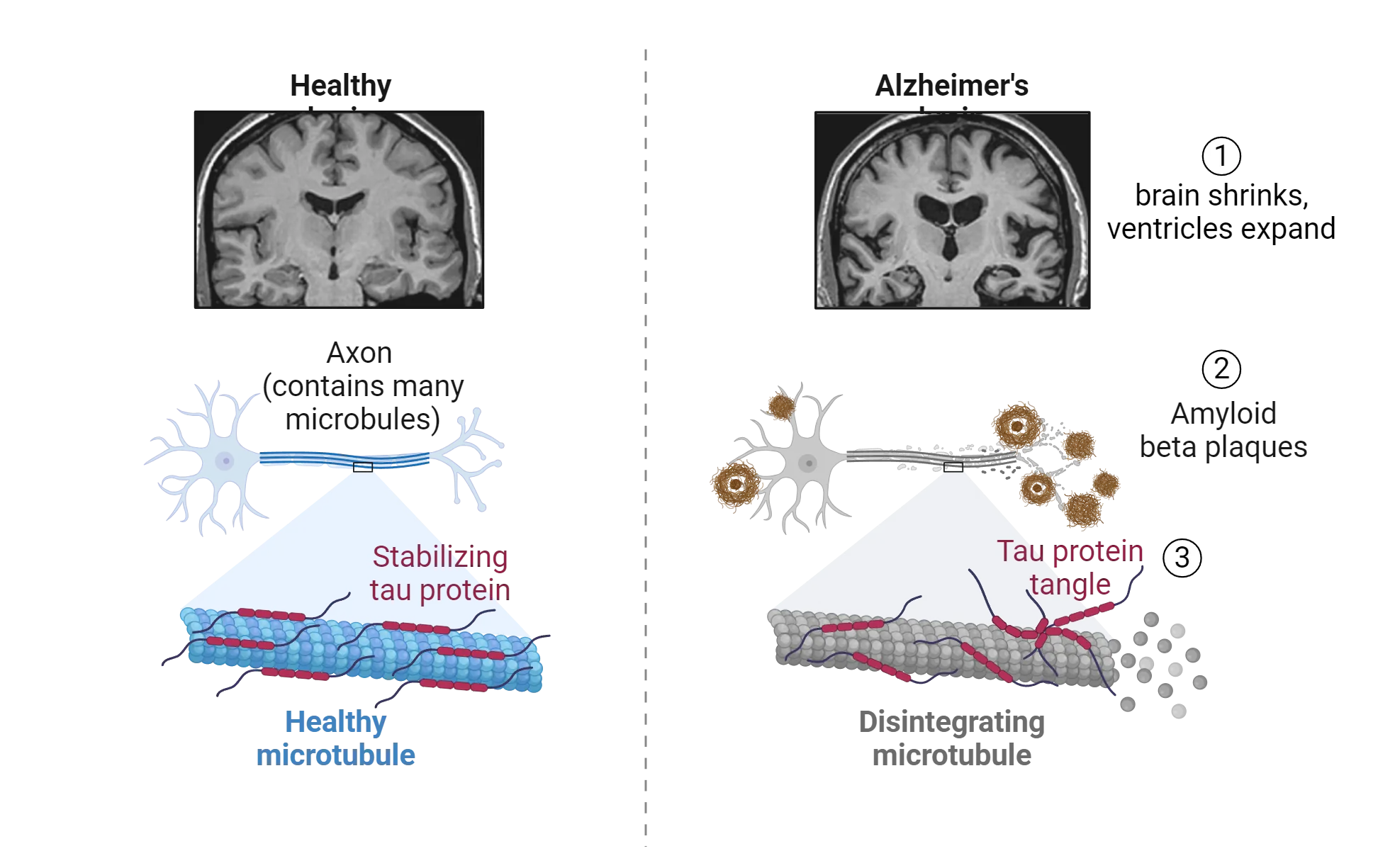 Pair of diagrams showing contrast between healthy and Alzheimer’s brains. Alzheimer’s brain: brain shrinks, ventricles expand (shown via MRI), Amyloid beta plaques accumulate outside a diagram of a neuron, tau proteins tangle and microtubules disintegrate inside axons (shown via diagram).