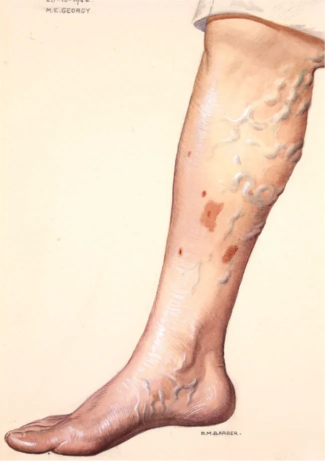 Diagram showing varicose veins in leg.