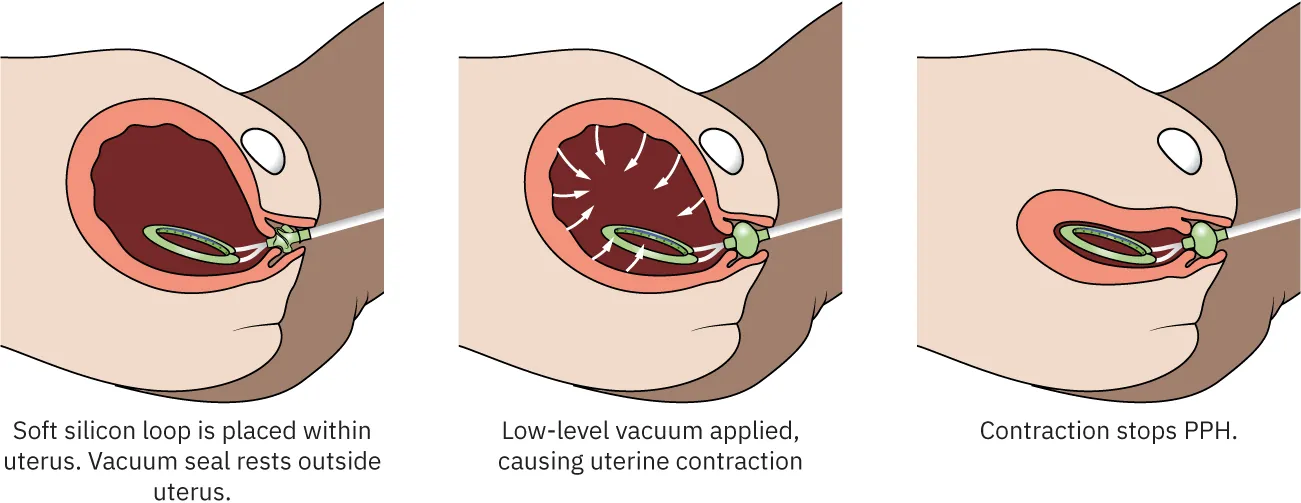 Diagram showing silicon loop being inserted into uterus while vacuum seal sits outside uterus. Low level vacuum is shown being applied, causing uterine contractions, and uterus returning to original size after.