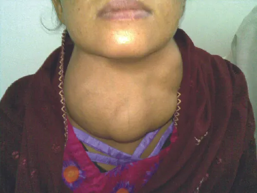 A person with a large swollen neck.