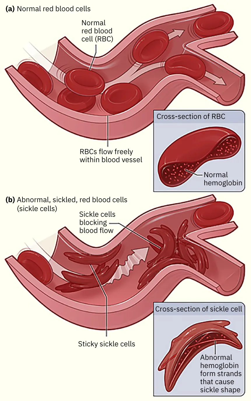 An illustration compares normal red blood cells with sickle cells. Normal cells flow freely through vessels. Sickle cells, depicted with abnormal hemoglobin, block blood flow and cause vessel blockage.