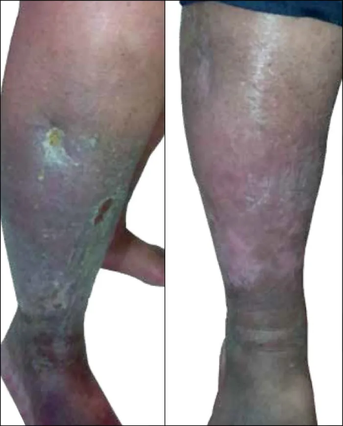 An image of a leg with venous insufficiency.