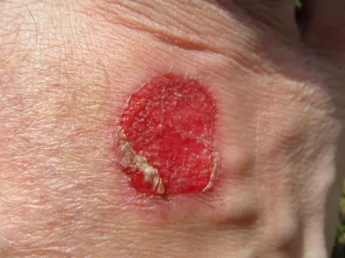 An image showing granulation.