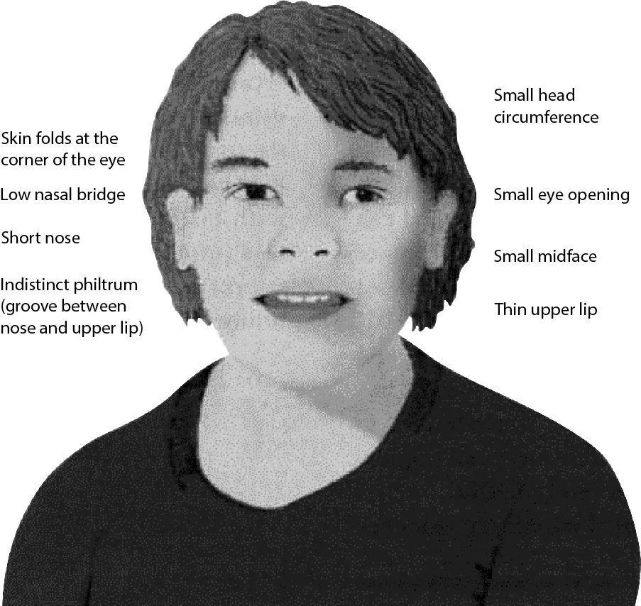 The image shows a drawing of a child with facial features of FAS. It includes the following labels: “Skin folds at the corner of the eye,” “Low nasal bridge,” “Short nose,” “Indistinct philtrum (groove between nose and upper lip),” “Small head circumference,” “Small eye opening,” “Small midface,” “Thin upper lip.”