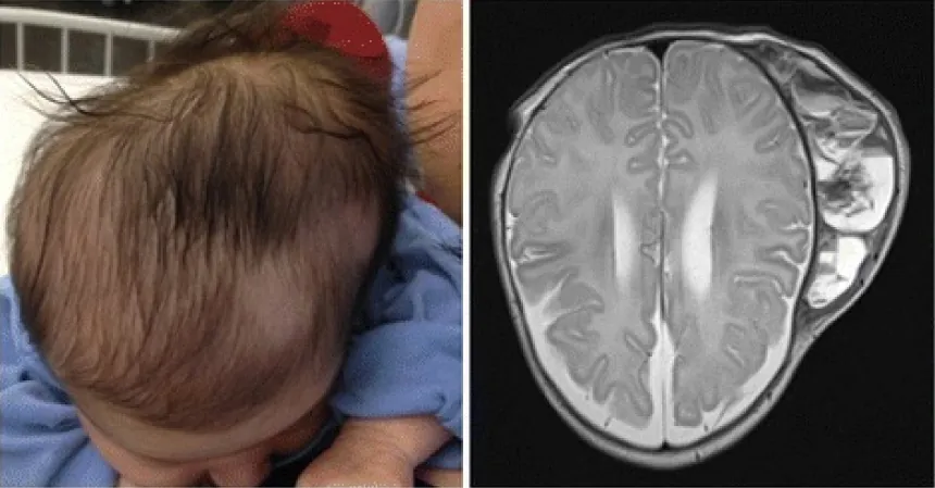 (left) Photo of infant with right back side of head protruding out. (right) MRI showing large mass on right back side of skull.