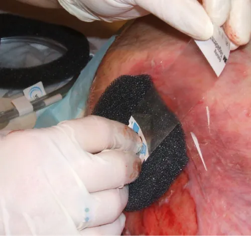 A gloved hand applies a transparent adhesive film (Tegaderm) over a black foam dressing on a patient's skin, which appears red and inflamed, indicating a medical procedure or wound care. Medical tubing is also visible.
