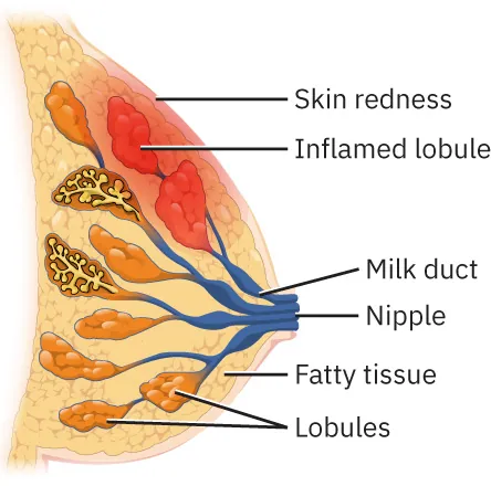 Image of inside of breast with milk duct, nipple, fatty tissue, and lobules labeled. Skin redness is shown on the outside above inflamed lobules colored red on the inside.