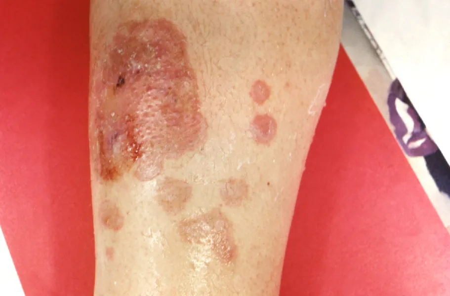 Numerous skin lesions of different sizes and color on a patient's forearm. One lesion is very large, dark, and scaly, while the others around it are coin sized circles.