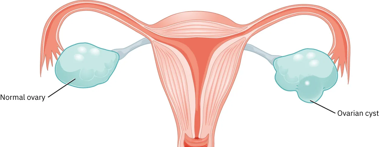 Image of uterus and fallopian tubes. Left ovary is normal, while right ovary displays ovarian cyst (enlarged bulbs visible extending out of the ovary).