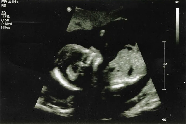 Ultrasound image of fetus in utero during the second trimester.