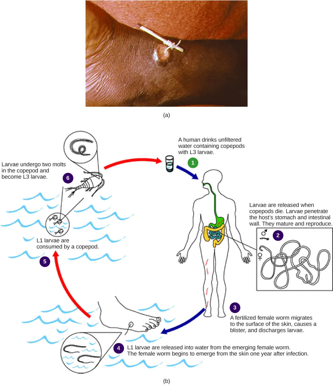 Part A shows a foot with a guinea worm extending from a blister. The end of the worm is wrapped around a stick. Part B shows the life cycle of the guinea worm, which begins when a person drinks unfiltered water containing copepods infected with guinea worm larvae. Larvae, which are released when the copepods die, penetrate the wall of the stomach and intestine. The worms mature and reproduce. Fertilized females migrate to the surface of the skin, where they discharge larvae into the water. Copepods consume the larvae. The copepods are consumed by humans, completing the cycle. About a year after infection, the female worm emerges from the skin.