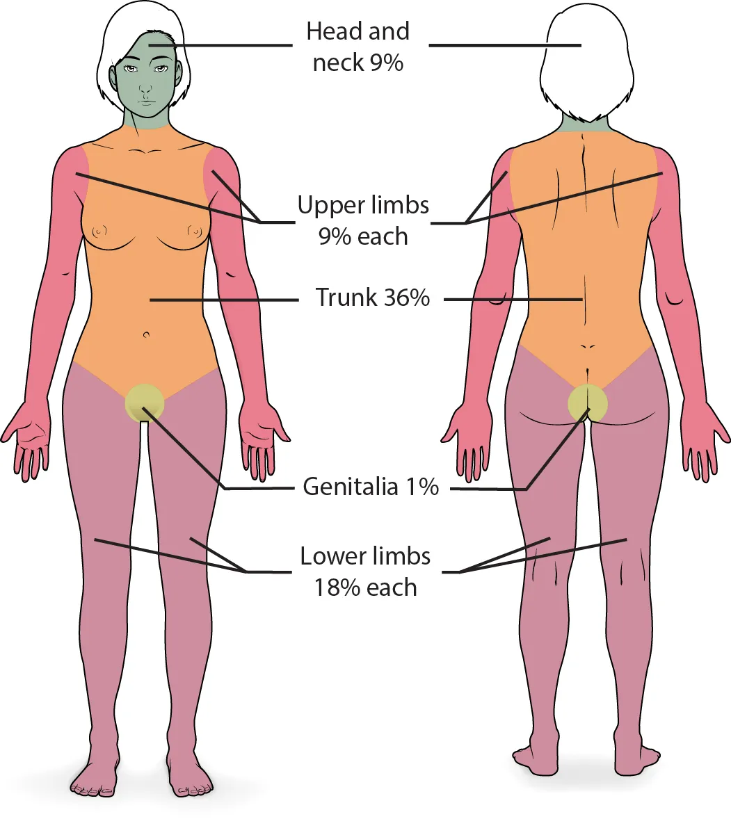 Image showing how to easily calculate the burn percentage for a patient.