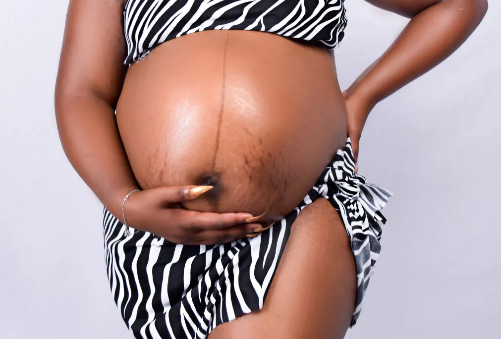 Photo of pregnant abdomen with dark line on the skin running down the middle.