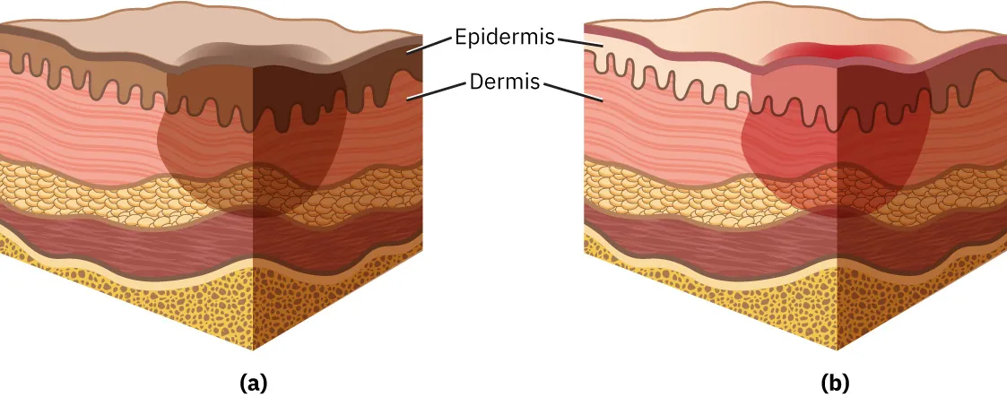 Stage I pressure injury: Figure (a) showing the area of concern as a different color than the surrounding skin. Figure (b) showing the area of pink and red erythema.
