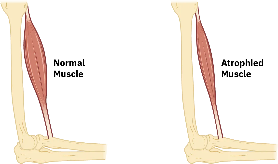 This image shows muscle atrophy. The left panel shows normal muscle and the right panel shows atrophied muscle.