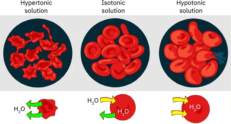 A color graphic showing hypertonic solution, hypotonic solution, and isotonic solution. The hypertonic fluid depicts blood cells that are shrunken and a diagram showing the flow of H20 out of the cells. The isotonic fluid depicts normal looking blood cells and shows H20 flowing in and out of the cells. The hypotonic fluid depicts swollen blood cells with a diagram showing the inflow of H20 into the cells.