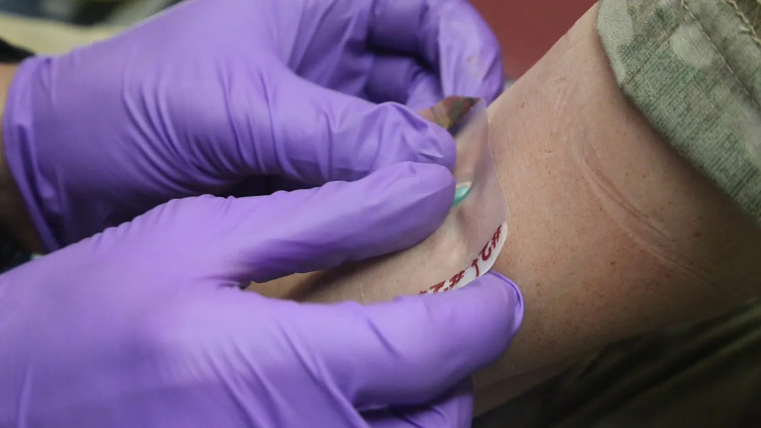 A person applies a transparent dressing to an entry point.