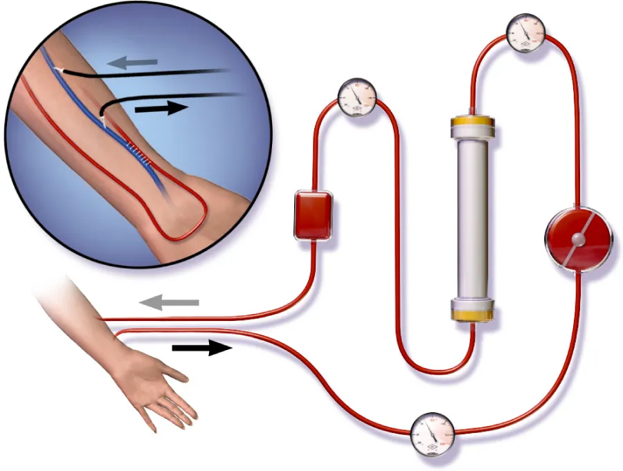An illustration showing the process of hemodialysis. Blood is drawn from a patient's arm through a needle, travels through a series of tubes connected to a dialysis machine that filters the blood, and then is returned to the patient's arm. The diagram includes pressure gauges and a dialyzer where the filtration occurs, with arrows indicating the direction of blood flow.