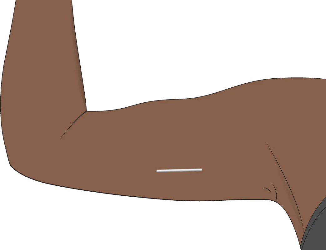Image of flat, line shaped contraceptive device inserted into inner upper arm.