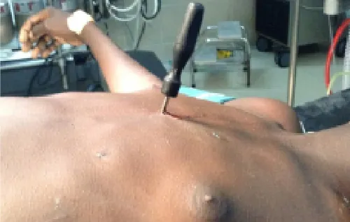 Example of an open wound.