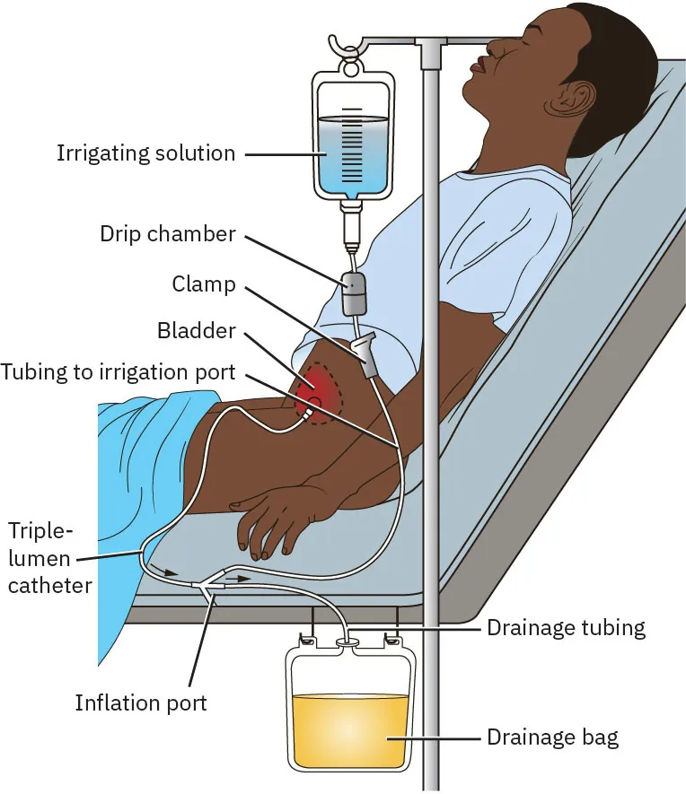 A complex color illustration showing a man wearing a three-way urinary catheter. The catheter is connected to an irrigation bag, a drainage bag, and the bladder of a man. Other labeled components include the drip chamber, clamp, triple-lumen catheter, tube to inflate balloon, tubing to irrigate port, and drainage tubing.