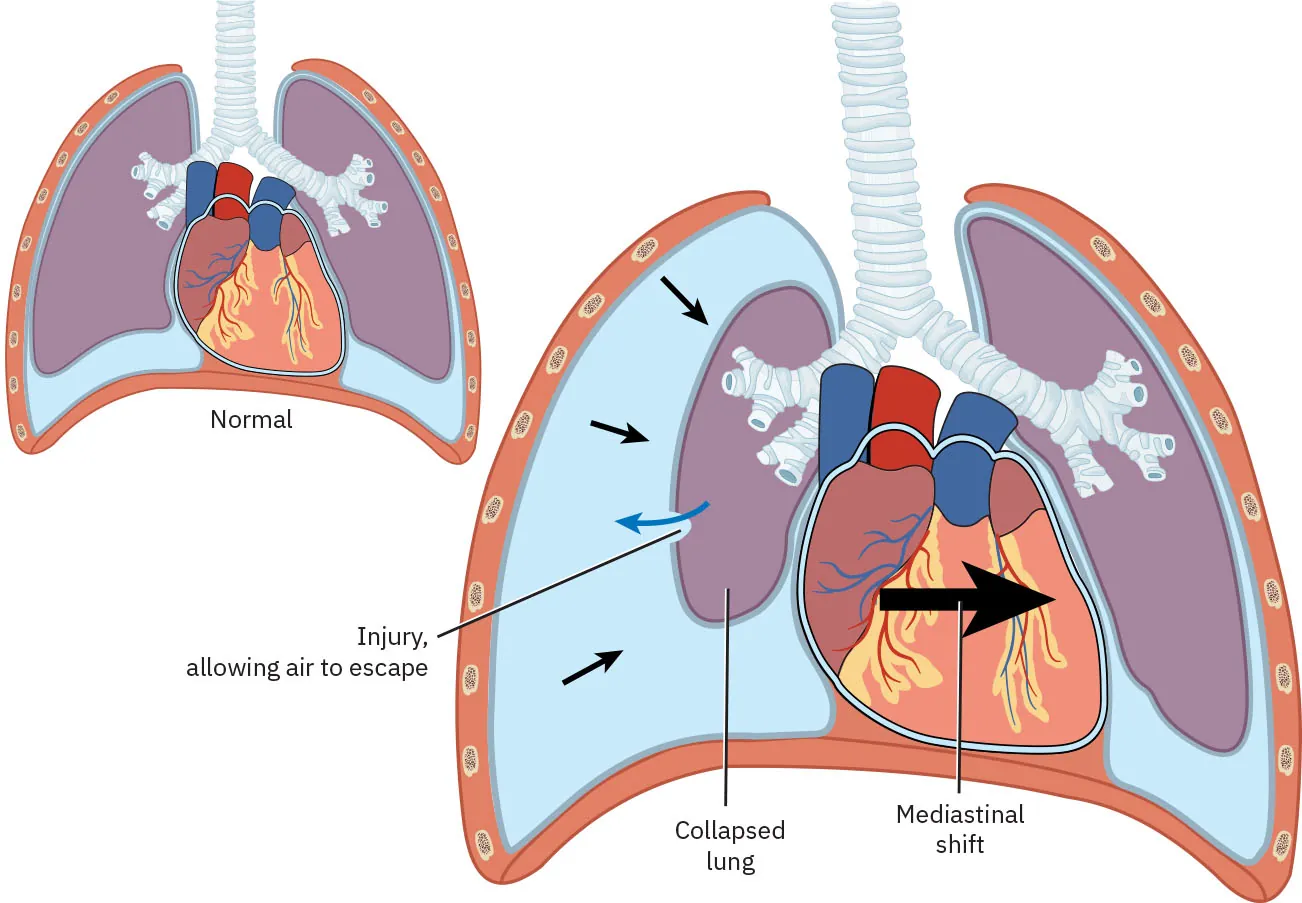 Diagram showing normal lung and heart, and collapsed lung with injury, allowing air to escape, and mediastinal shift.