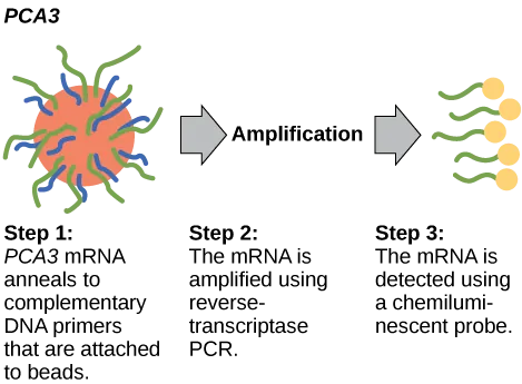 The P C A 3 test occurs in three steps. In step one, P C A 3 m R N A anneals to complementary D N A primers that are attached to beads. In step two, the m R N A is amplified using reverse-transcriptase P C R. In step three, the m R N A is detected using a chemiluminescent probe.