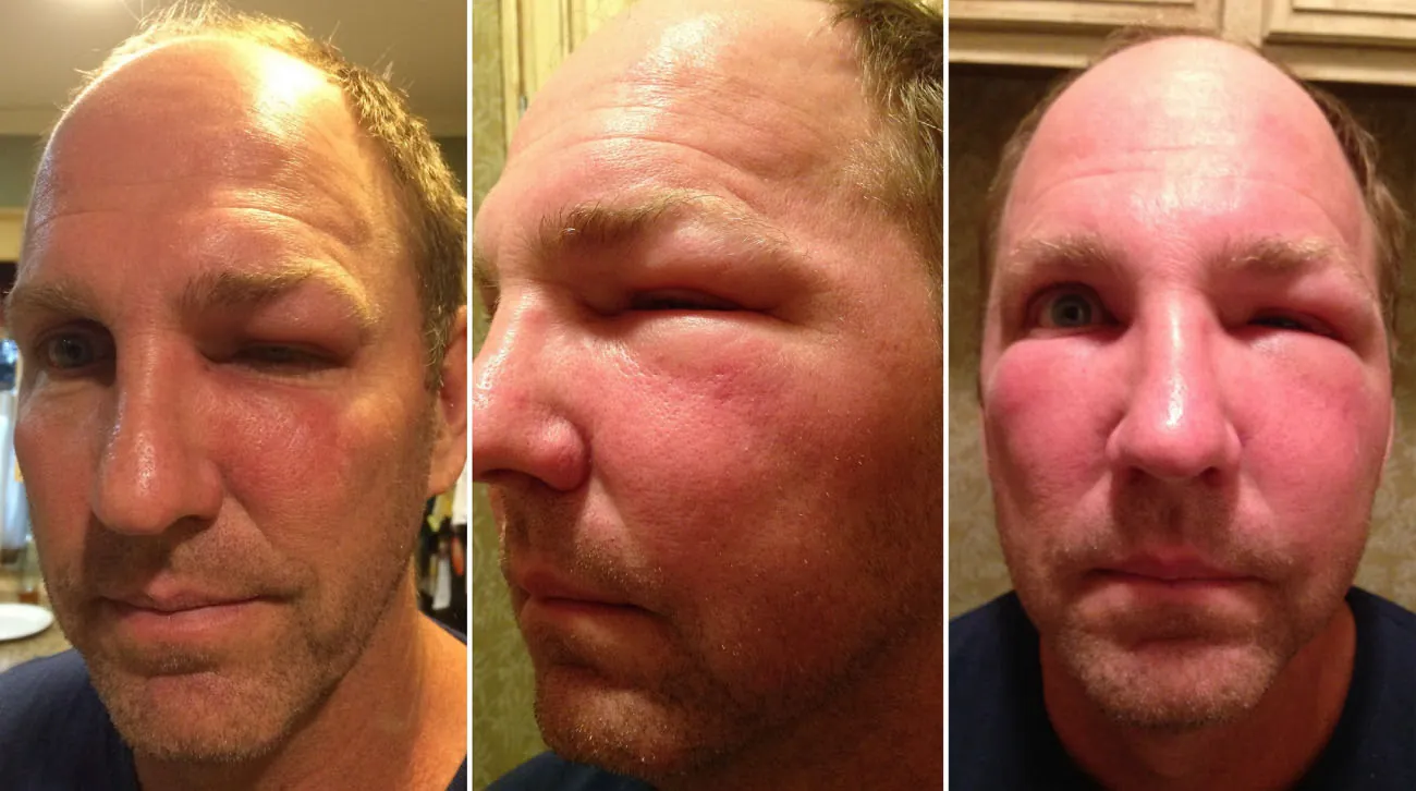 Three photos of an individual’s face as the left side of their face and their left eye become increasingly swollen and the eyes becomes closed.
