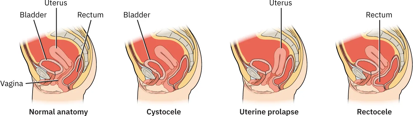Images of pelvic organ prolapse: normal anatomy (uterus, bladder, rectum, vagina in correct position), cystocele (bladder leaning forward), uterine prolapse (uterus pushing against rectum), rectocele (rectum protruding forward into vagina).