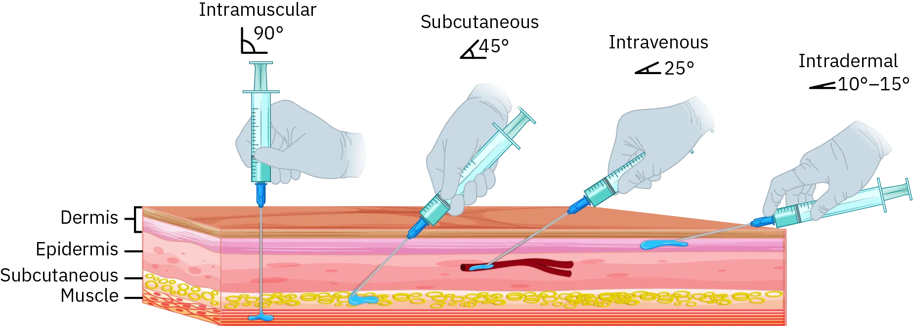 Two drawings show what tissue layer different types of injections need to reach and what angle the needle needs to be held at while injecting. The first drawing shows how deep each type of injection needs to go. Intramuscular injections need to reach the muscle; subcutaneous injections need to reach the subcutaneous tissue; intravenous injections need to reach the dermis; and intradermal injections only need to penetrate the epidermis. The second drawing shows the angle the needles need to be at when administering medication. Intramuscular injections need to be at a 90 degree angle, the needle is perpendicular to the skin; subcutaneous injections need to be at a 45 degree angle; intravenous injections need to be at a 25 degree angle; and intradermal injections need to be at a 10 or 15 degree angle, or almost parallel to the skin.