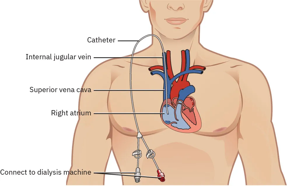 A color illustration showing the location of a temporary dialysis catheter connected to the central vein.
