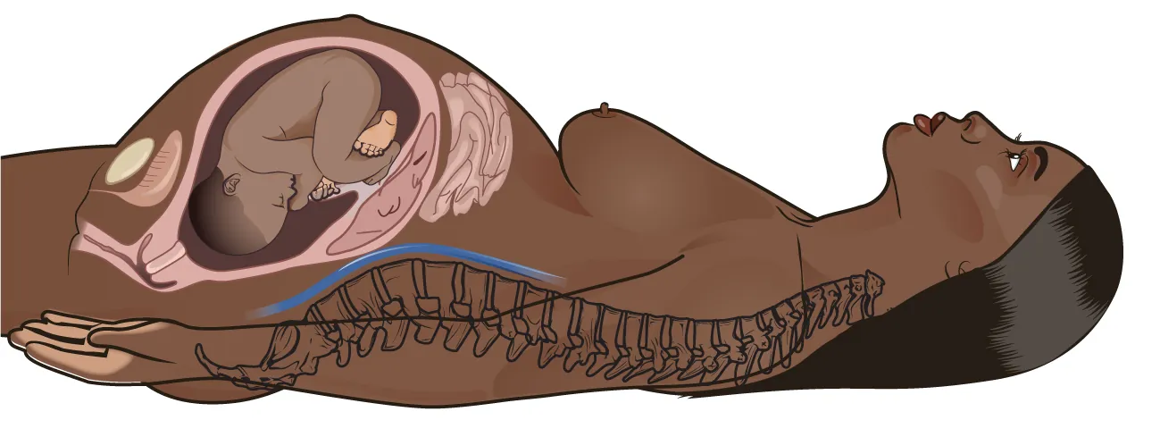 Illustration of pregnant person lying on back with positioning of fetus shown