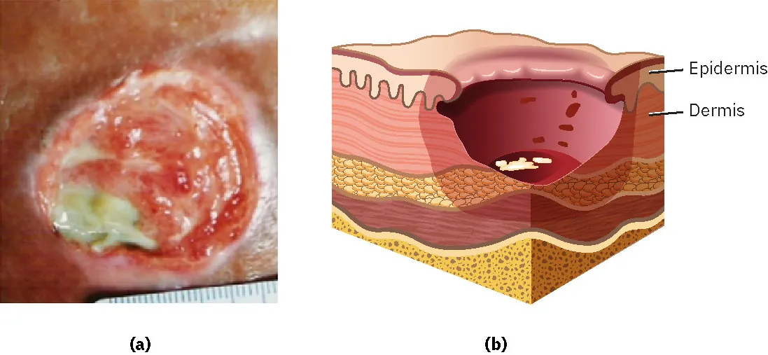 A photograph of a stage 3 pressure injury where there is loss of skin and tissue below the dermis. There is a diagram showing the same injury.