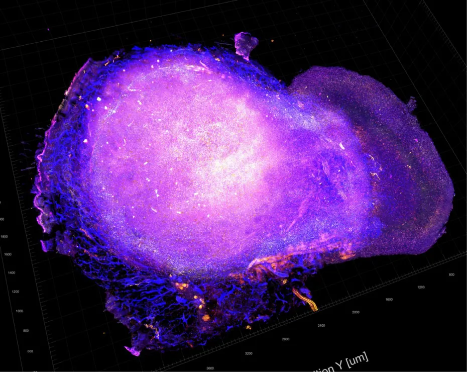 Transparent tumor tomography showing cytotoxic T cells attacking the tumor