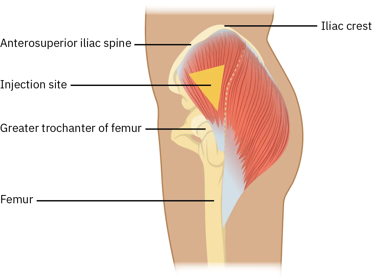 A diagram shows the injection site for a ventrogluteal injection. A drawing of a hand is shown over the femur. The palm is over the greater trochanter of the femur. The index finger is over the anterior superior iliac spine. The middle finger points to the iliac crest. The injection site is located at the middle of the triangle formed by the index and middle finger.