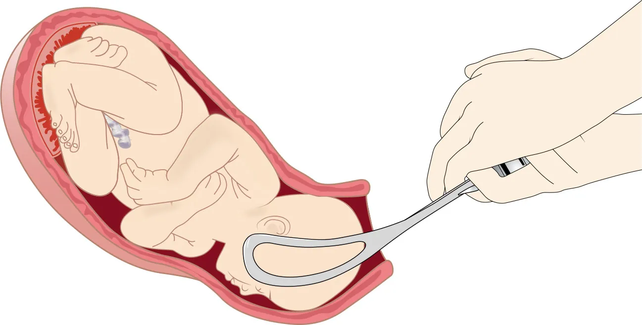 Image of fetus being assisted out of the womb with forceps.