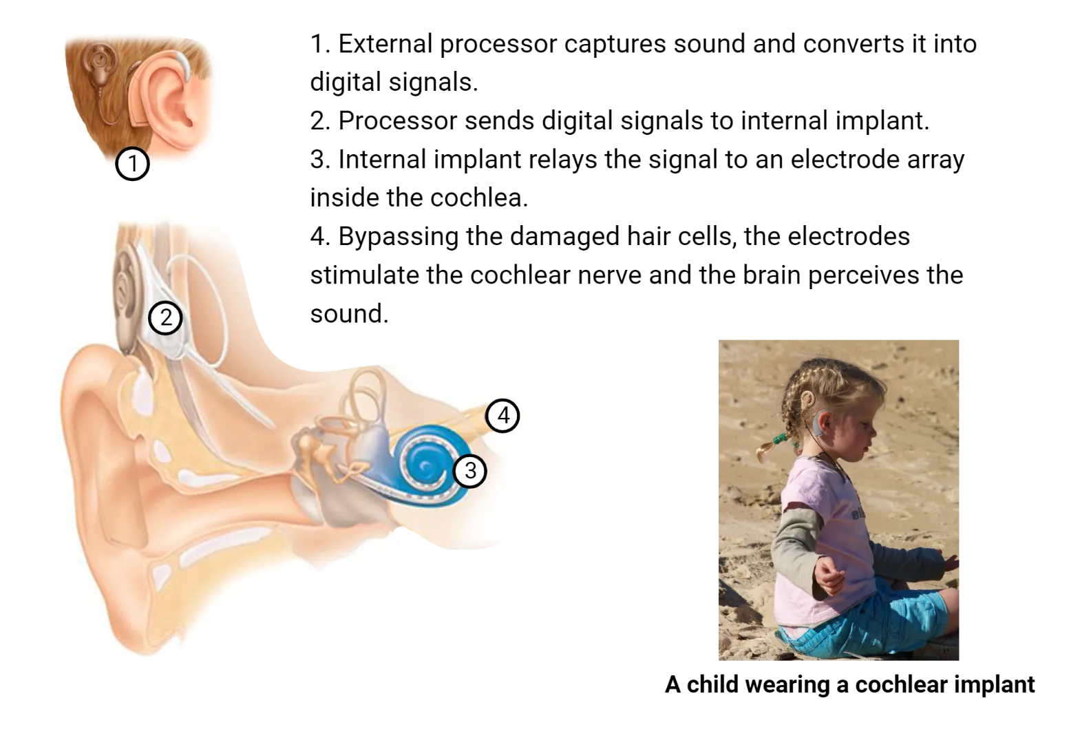 Left: Diagram of the major pieces of a cochlear implant: external processor, internal implant, cochlear implant. Right: Picture of a child playing in sand while wearing a cochlear implant.