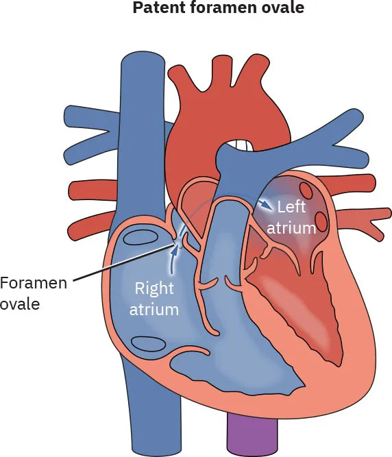 Diagram showing patent foramen ovale, labeling foramen ovale, right atrium, and left atrium.