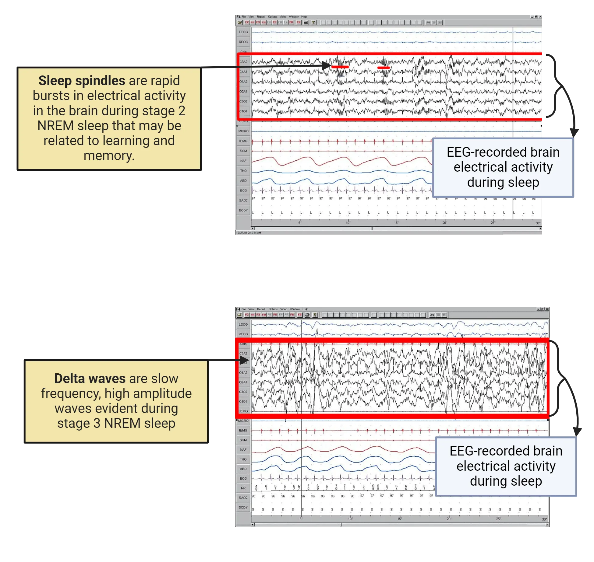 Screenshots of EEG traces showing sleep spindles and delta waves. Sleep spindles are rapid bursts in electrical activity in the brain during stage 2 NREM sleep that may be related to learning and memory. Delta waves are slow frequency, high amplitude waves evident during stage 3 NREM sleep.