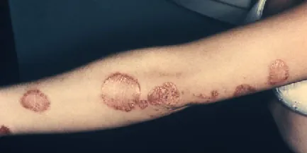 Plaque psoriasis on arm.