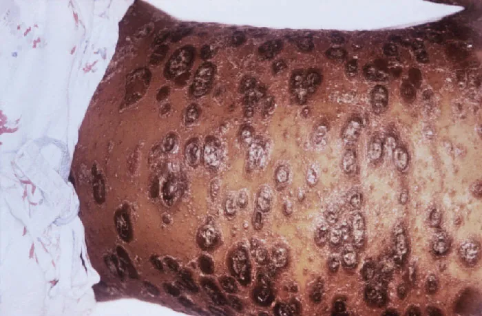 Photo of numerous red, elevated, scaling lesions on an individual’s abdomen due to psoriasis.