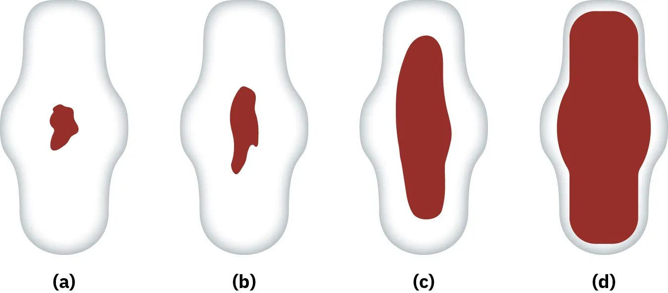 Diagram showing varying amounts of lochia in postpartum period: (a) scant; (b) small; (c) moderate; and (d) heavy.