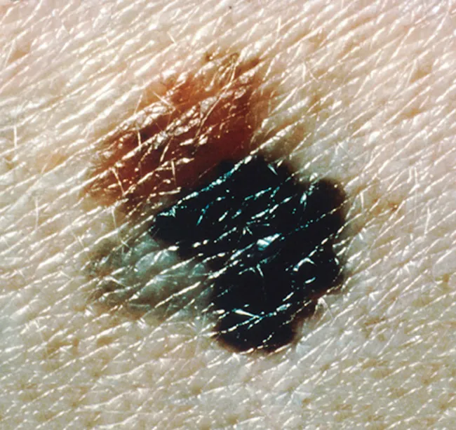 Melanoma showing blue-black color and irregular border and surface