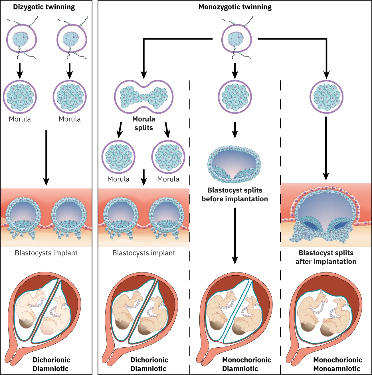 Diagram showing types of twins. Dizygotic twins start as two embryos that implant into the uterus, resulting in a dichorionic diamniotic pregnancy. Monozygotic twins are formed when the morula splits, resulting in a dichorionic diamniotic pregnancy; when the blastocyst splits before implantation, resulting in a monochorionic diamniotic pregnancy; and when the blastocyst splits after implantation, resulting in a monochorionic monoamniotic pregnancy.