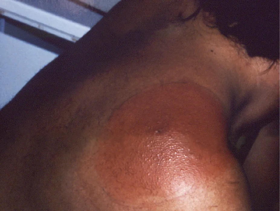 A bullseye-shaped rash spreads over a person's shoulder. It is dark in the center and fades subtly as it expands out.