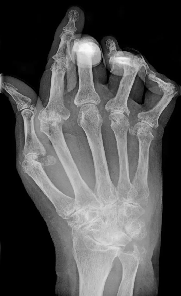 X-ray showing rheumatoid arthritis in a hand